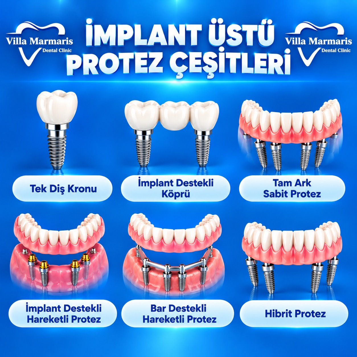 İmplant üstü protez çeşitleri