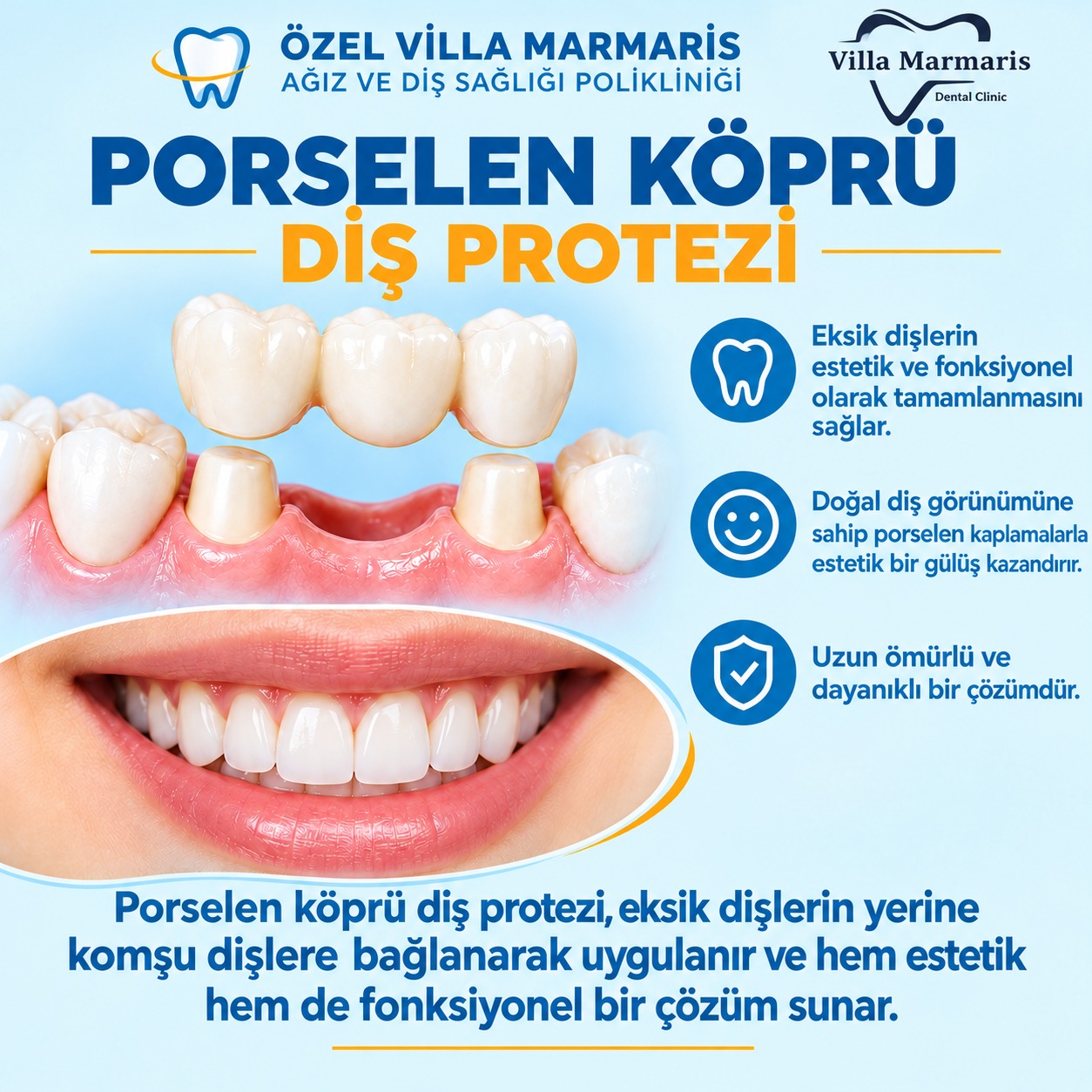 Porselen köprü diş protezi