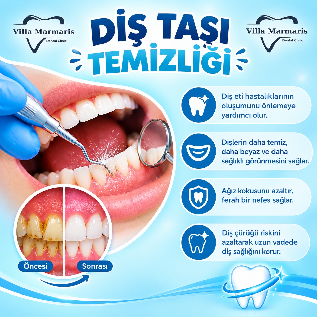 Diş taşı temizliği
