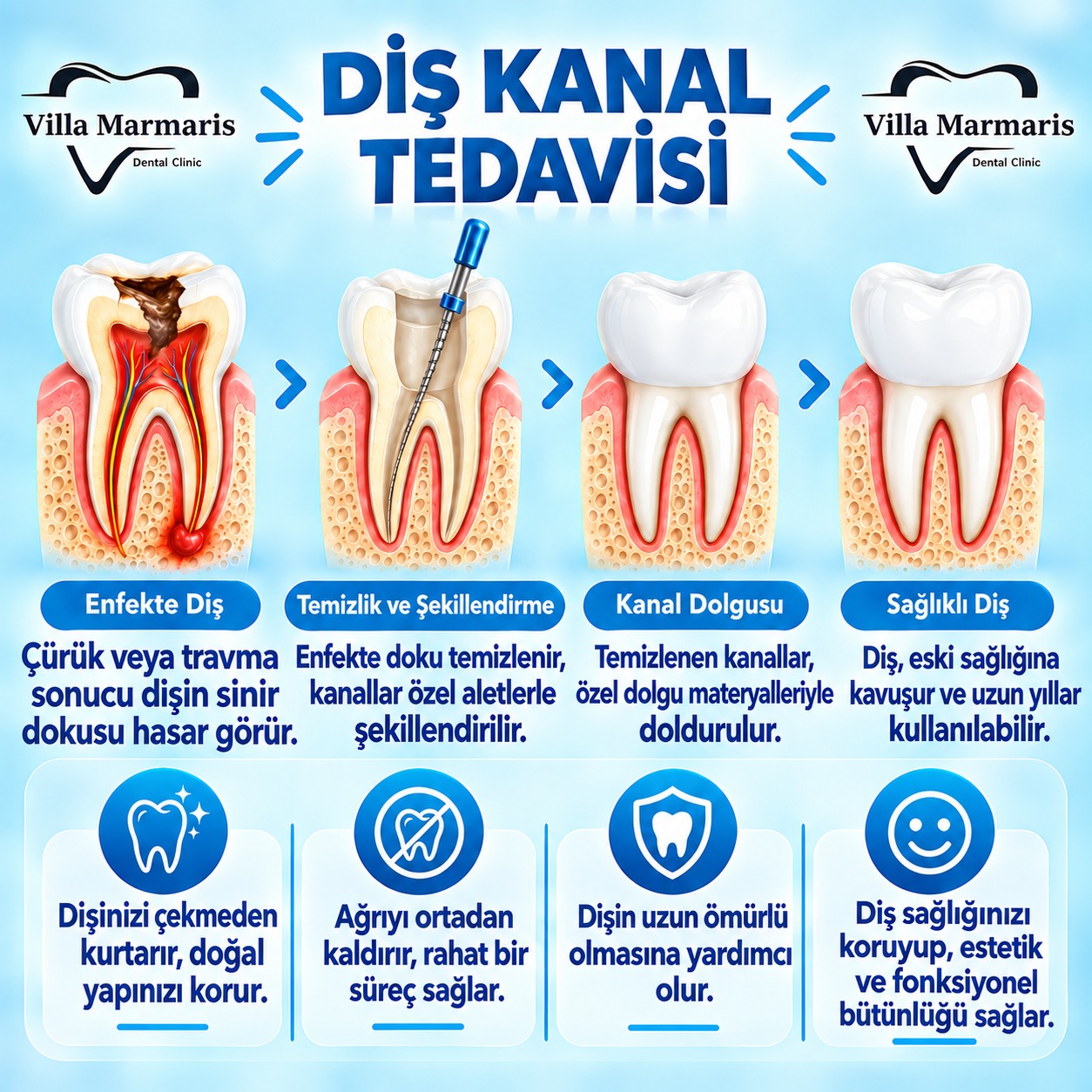 Diş kanal tedavisi