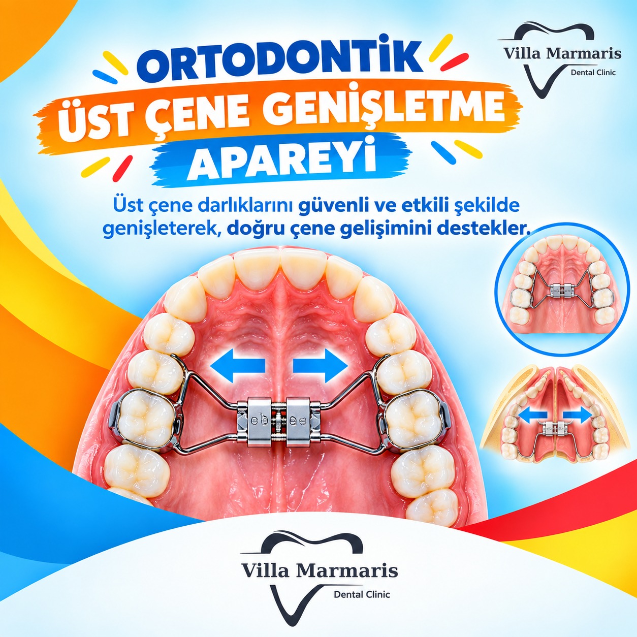 Üst çene genişletme apareyi