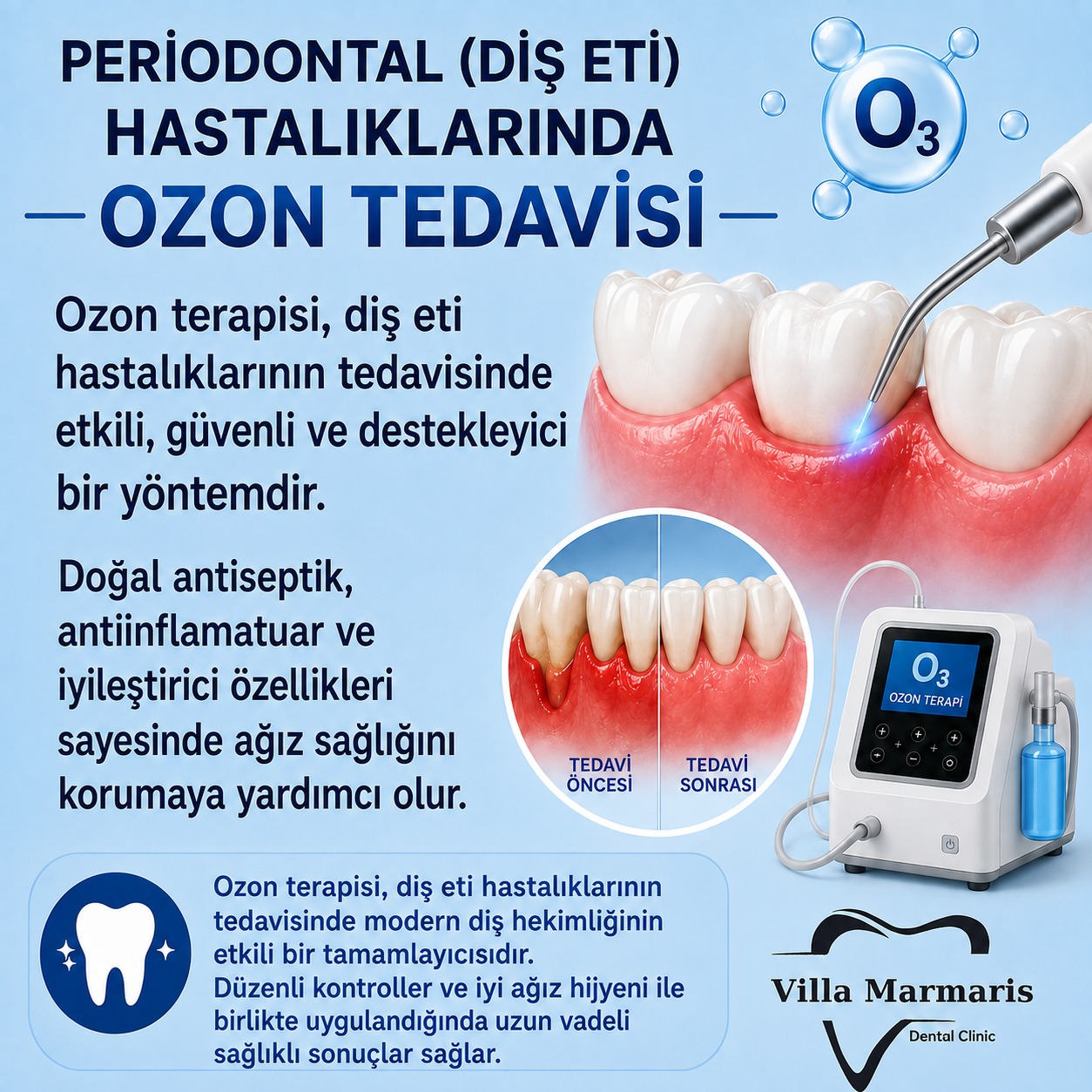 Diş eti hastalıklarında ozon tedavisi