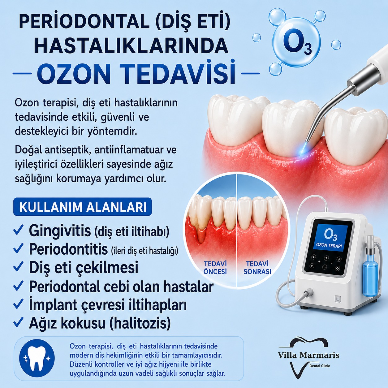 Periodontal tedavide ozon uygulaması
