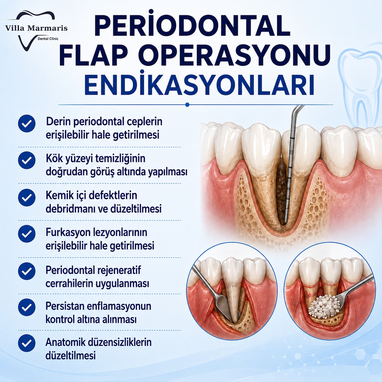 Periodontal flap operasyonu