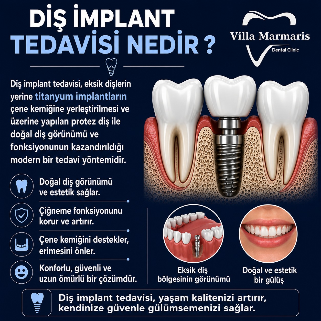 Diş implant tedavisi