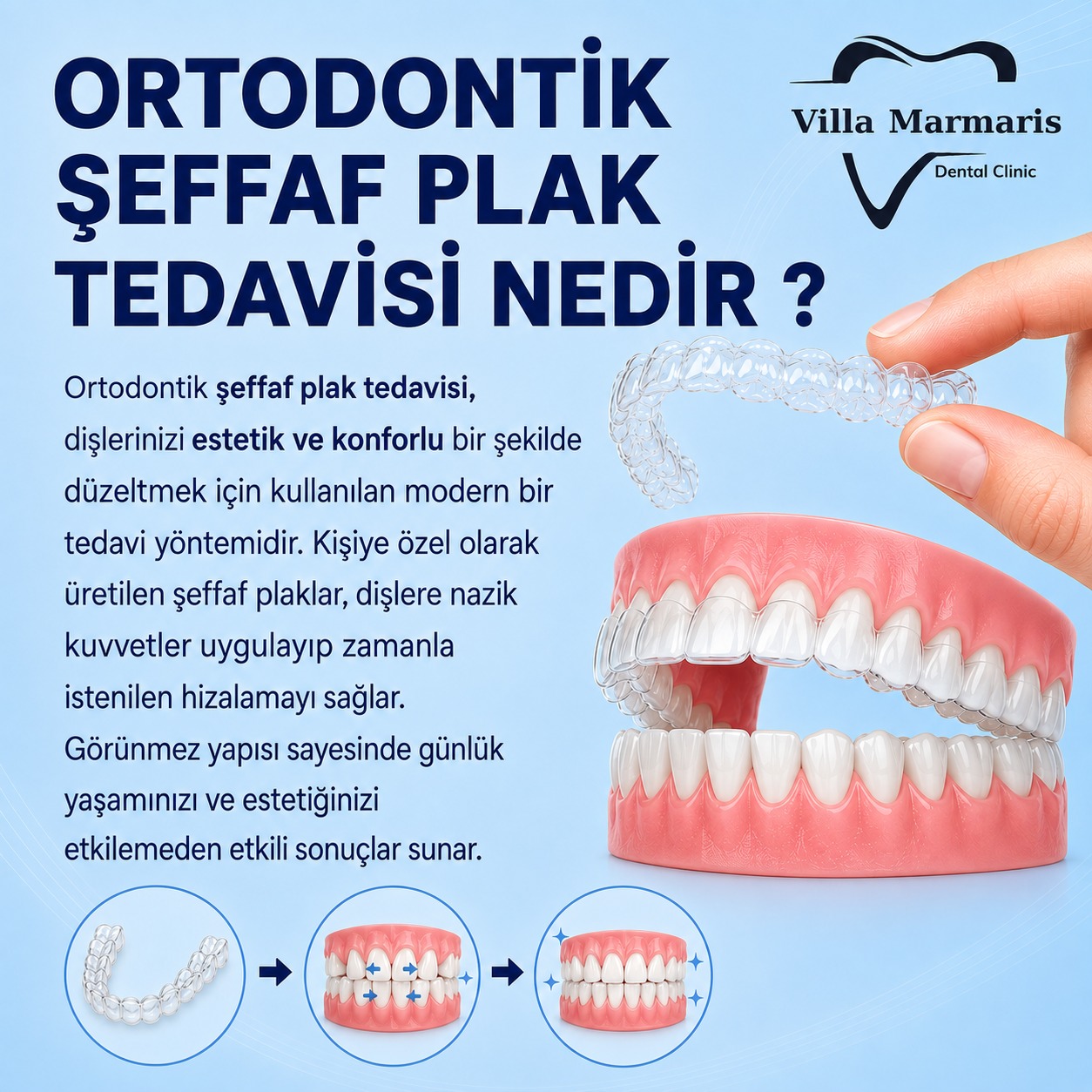 Şeffaf plak tedavisi nedir?
